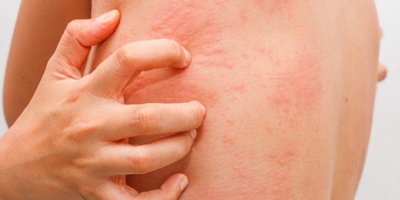 Allergiyası olanlara vacib xəbər - TAM SAĞALMAQ...